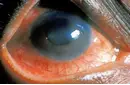 Romatoid Artrit Göz Bulguları